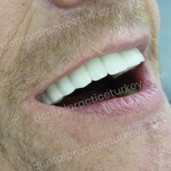 Dental Practice Turkey Announces Full Mouth Dental Implants 